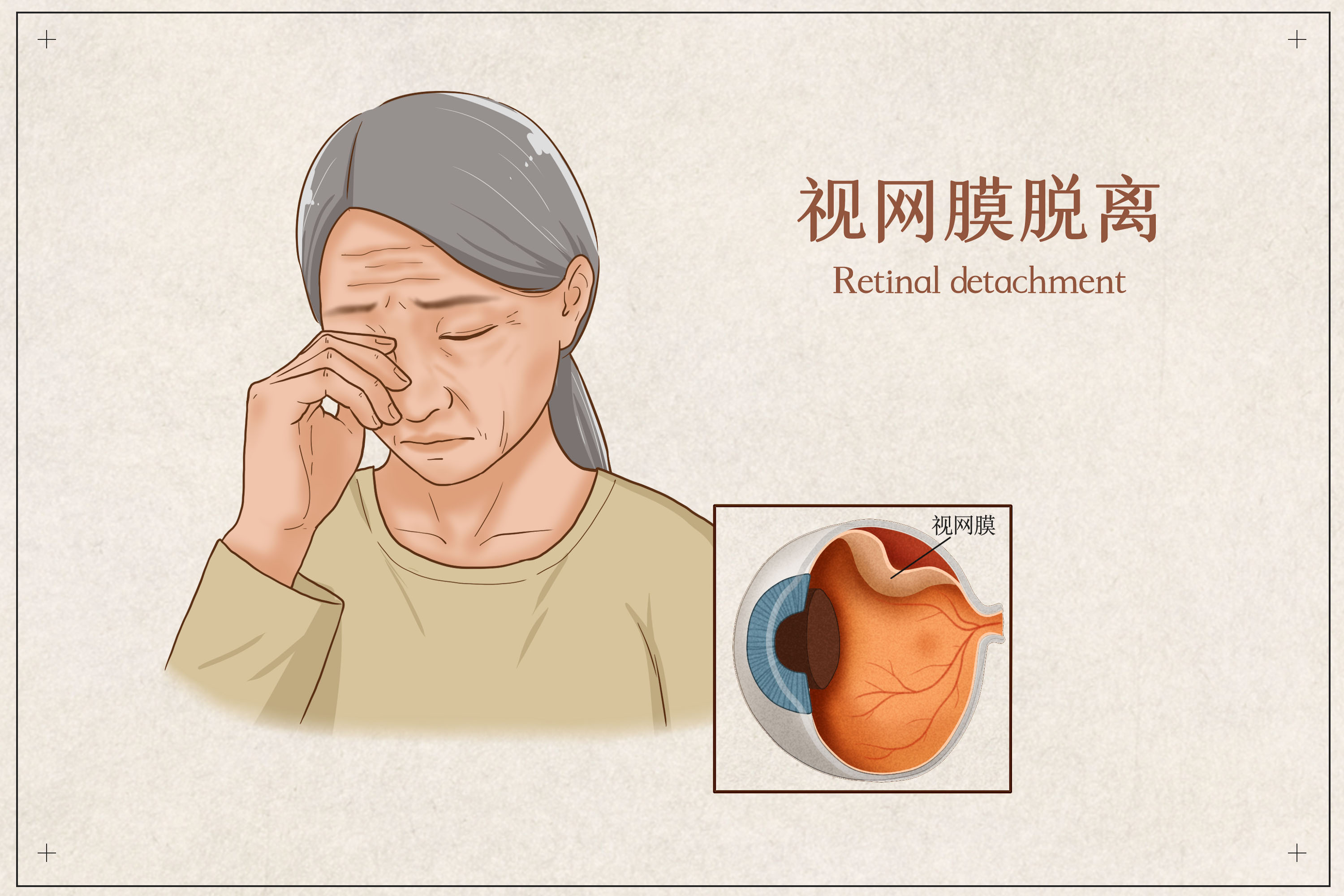 視網膜脫落癥狀